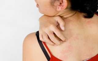 Крапивница: как лечить симптомы аллергии