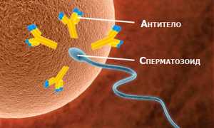 Агглютинация сперматозоидов: как лечить опасный процесс