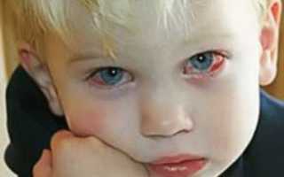 Как устранить отек глаз при аллергии?