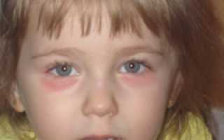 Как «бороться» с кругами под глазами у ребёнка?