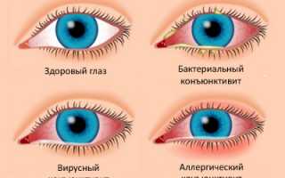 Самые эффективные глазные капли при конъюнктивите