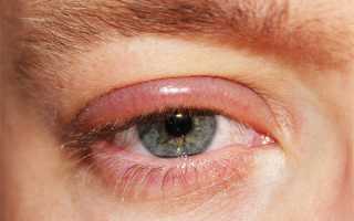 Глаза опухли и болят — причины и лечение в домашних условиях