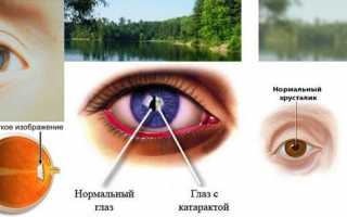 Глазные капли Орлит – эффективное профилактическое средство или пустышка