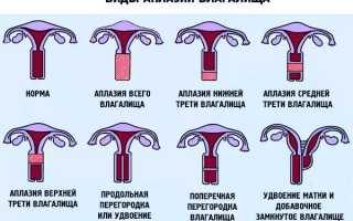 Аплазия матки : Причины и Диагностика недуга