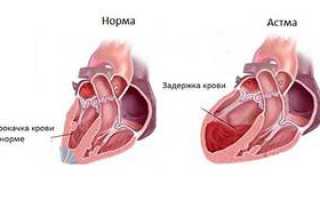 Что это такое – астма сердца, симптомы и лечение