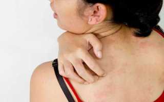 Зуд кожи тела – причины и лечение