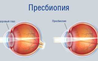 Причины и симптомы факосклероза хрусталика глаза