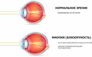Мышцы глаза и возможные их патологии