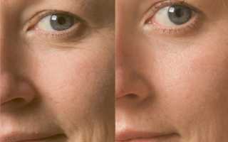 Алмазный пилинг кожи лица: нюансы и особенности проведения