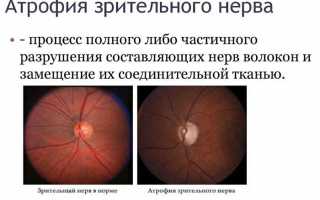 Причины и терапия атрофии зрительного нерва