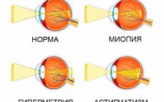 Риски развития аметропии глаза — лечение и профилактика