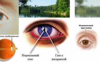Что входит в оптическую систему глаза — функции и заболевания