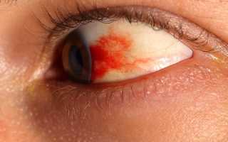 Что важно знать о красных пятнах в глазах?