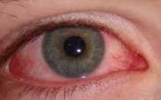 Почему появляются красные капилляры в глазах?