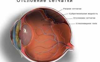 Причины отслоения сетчатки глаз и методы сохранения зрения