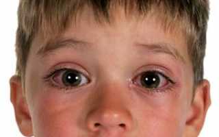 Аллергический конъюнктивит у ребенка — причины и лечение