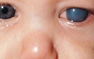 Причины и симптомы глаукомы — лечение и профилактика патологии зрения