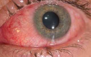 Глазные капли Левомицетин — как использовать и чем заменить?