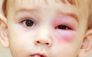 Красные круги под глазами у детей — нужно ли беспокоиться