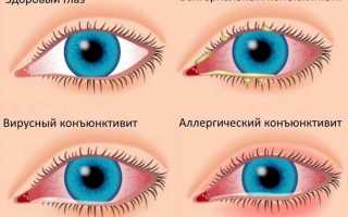 Применение глазных капель Кромофарм
