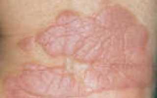 Красные пятна на коже – какие бывают виды, причины появления и методы лечение