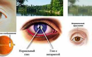 Особенности профилактики катаракты