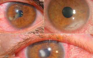 Применение глазных капель Окомистин для детей