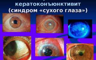 Лечение взрослых и детей глазными каплями Офтальмоферон