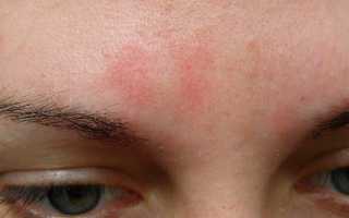 Красные шелушащиеся пятна на лице: причины, симптомы и лечение