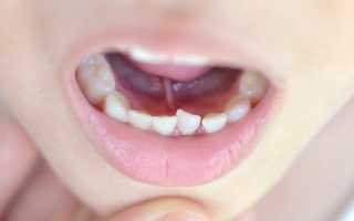 Красный плоский лишай в полости рта: причины, симптомы и лечение