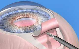 Операция катаракты при глаукоме