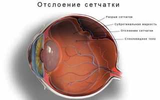 Особенности развития и лечения пигментного ретинита