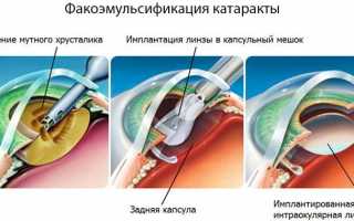 Симптомы и особенности лечения при незрелой катаракте