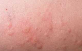 Как выглядит аллергическая сыпь? Кожные высыпания у ребенка