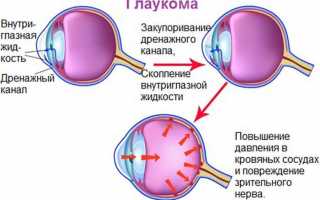 Как применяют Офтан Тимогель для лечения глаукомы