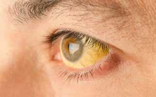 Желтые глаза у людей: симптом опасной патологии или норма?