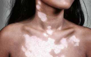 Причины появления белых пятен на коже, виды и методы лечения