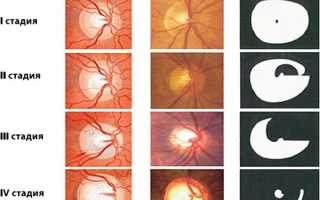 Классификация и стадии развития глаукомы