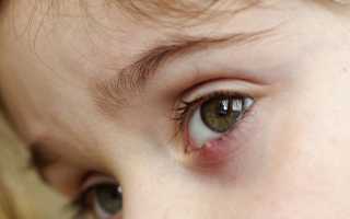 Лечение ячменя на глазу у детей — как правильно действовать?