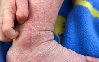 Как выглядит дерматит у ребёнка и его разновидности