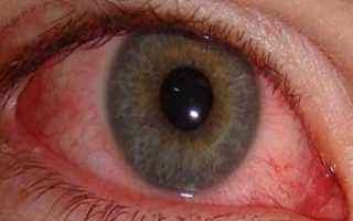 Покрасневшие глаза у ребенка: причины, симптомы, лечение