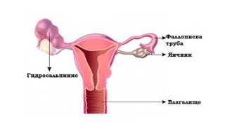 Беременность и гидросальпинкс: возможно ли зачатие?