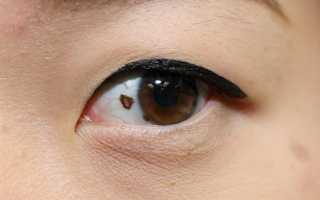 Причины появления жёлтого пятна на глазу и его лечение