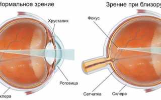 Показания и противопоказания к лазерной коррекции зрения