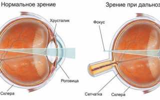 Симптомы глазного давления и лечение в домашних условиях