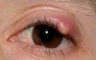 Шишки на веках глаз — причины и лечение в домашних условиях